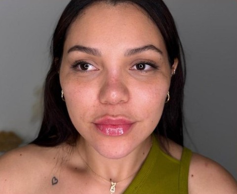 Client after Non-Surgical Liquid Facelift