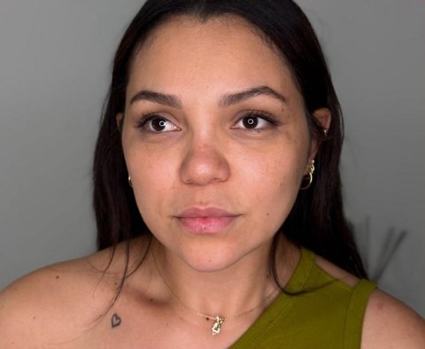 Client before Non-Surgical Liquid Facelift